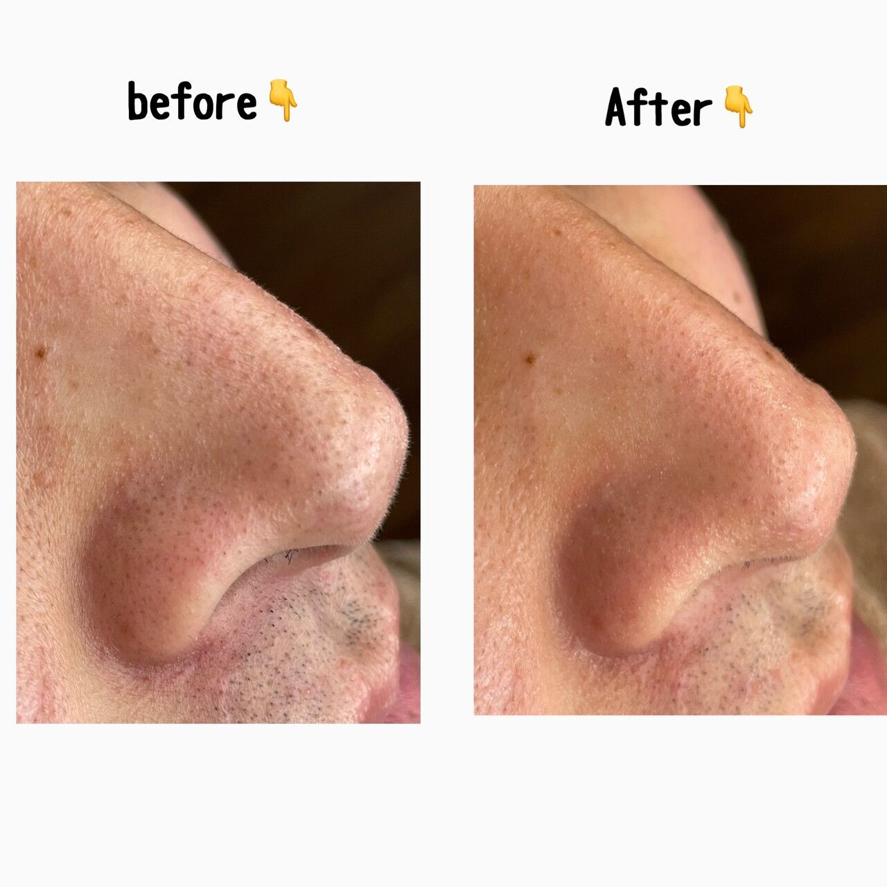 SNSで話題の毛穴洗浄☆【ハイドロヴィーナス】はTAMAHADAで！ | 熊本に